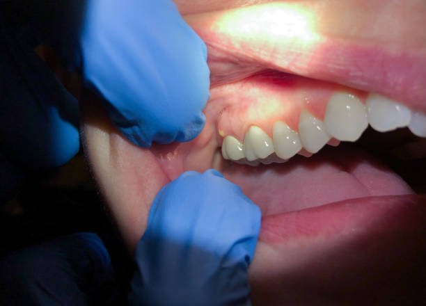 Best Knocked-Out Tooth (Avulsed Tooth) Treatment in Montrose, NY